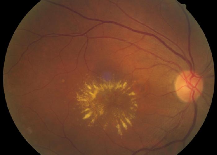 Hypertensive Retinopathy HKU E learning Platform In Clinical 